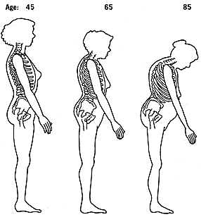 Shrinking woman due to age and weakening of bones
