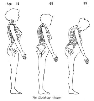 Shrinking woman due to age and weakening of bones