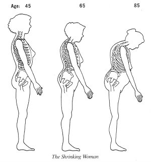 Shrinking woman due to age and weakening of bones