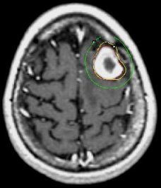 Picture of brain Metastatsis Day of Radiosurgery