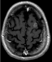 Picture of brain Metastatsis 5 months later