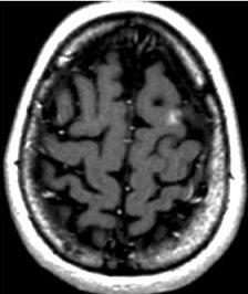 Picture of brain Metastatsis 3 years later