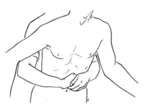 Example of the Heimlich Maneuver for standing or sitting patient. Press the fist up and into the stomach with a sharp thrusting motion