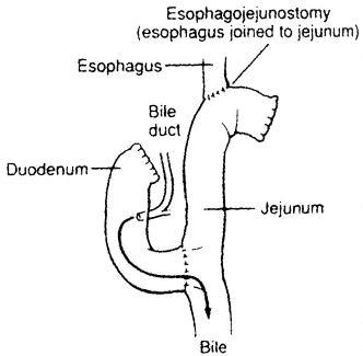total gastrectomy graphic of a esophagojejunostomy