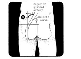 choosing upper-outer quadrant of buttock for shot, avoid injecting near the major nerve and artery