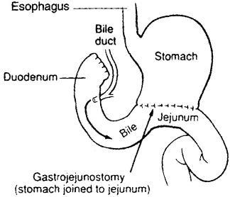 partial gastrectomy 